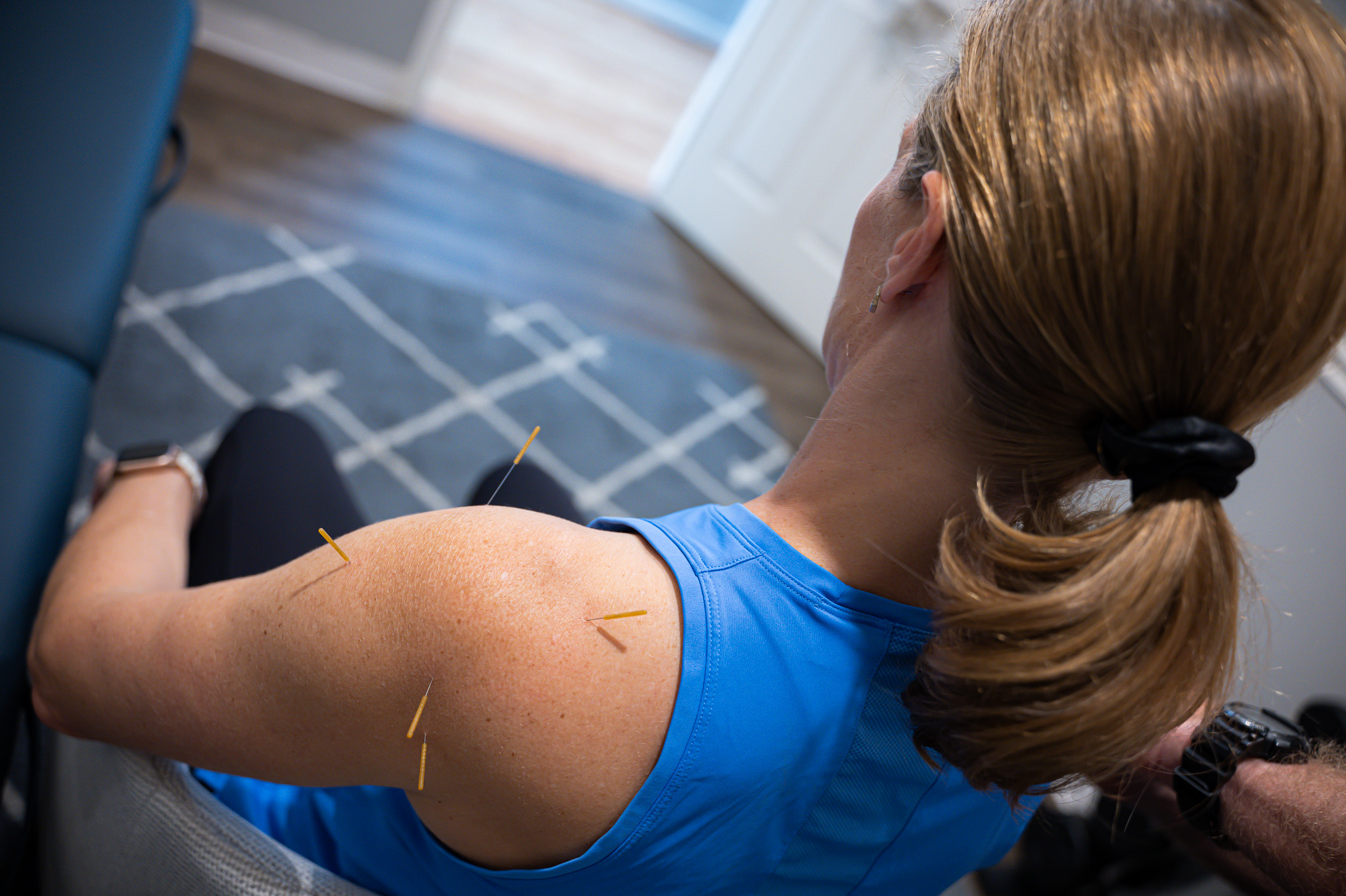 5-reasons-to-try-dry-needling
